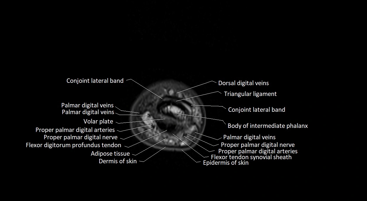 Finger anatomy axial cross sectional 3T image image 8.webp